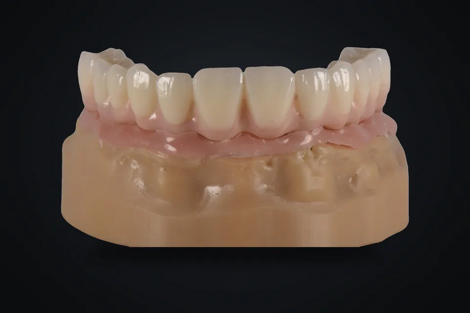 Model üzerinde implant üstü köprü