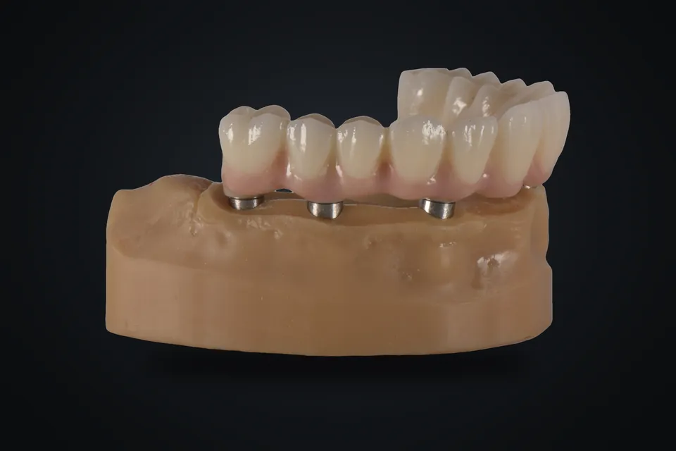 İmplant analoglu model üzerinde köprü