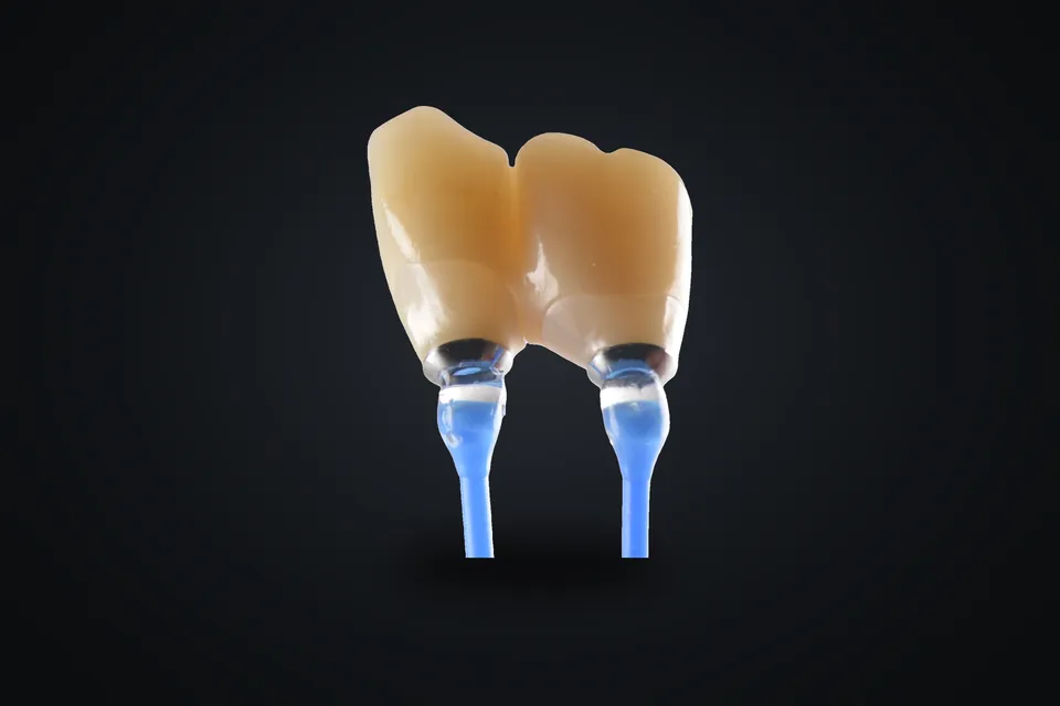 Ti-base üzerinde implant kronlar