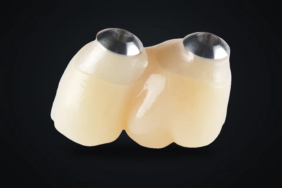 Vida tutuculu implant kronlar