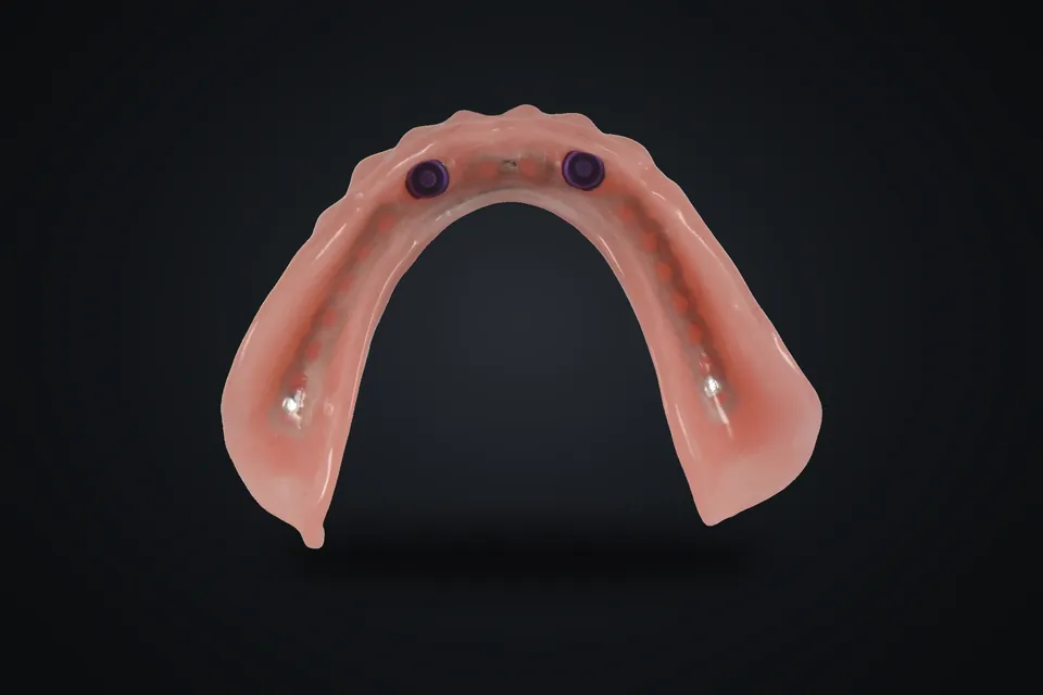 Overdenture doku yüzeyi ve tutucu yuvaları