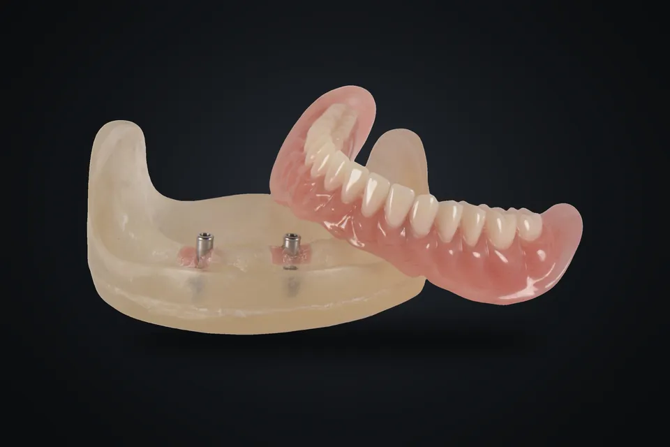 Overdenture ve şeffaf model